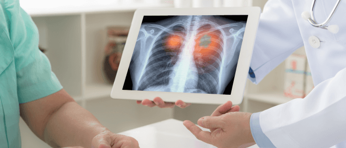 Best Lung Cancer Treatment in India