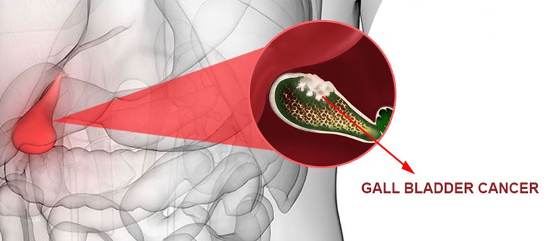 Gallbladder Cancer