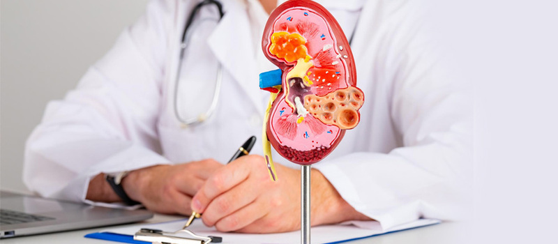 Renal Cell Carcinoma (RCC): Symptoms, Diagnosis, and Leading Treatments