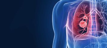 best lung cancer hospital india