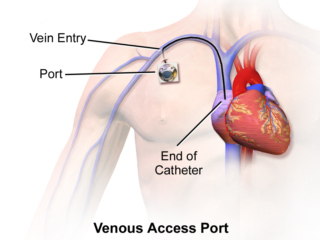 Implanted chemoport beneath the chest skin, connected to a catheter in a central vein.