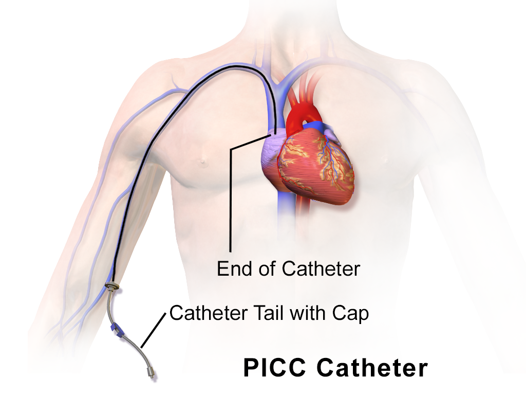 PICC catheter route from the arm to a central vein, showing the external tubing.