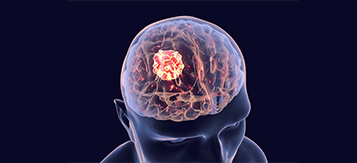 Brain Tumor