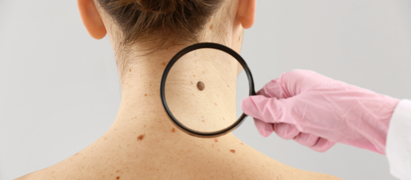 Melanoma Cancer: Symptoms, Causes, Diagnosis and Treatment