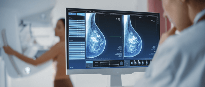 Breast Cancer – Diagnosis & Treatment